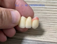 奥克兰专业牙科诊所义齿供应商Myy国际出口合作 义齿厂家